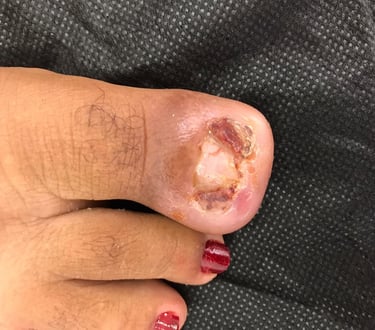 Unha encravada, Salvador/Bahia