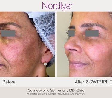 before and after rosacea and redness treatment results in Hamilton