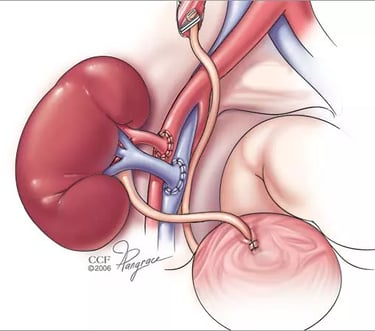 زراعة الكلى د. عمر حمدالله عمان الأردن