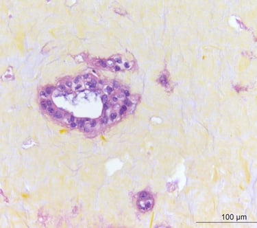 Human cancer tumor showing an area with hypoxia in the center. CTIBIOTECH