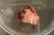 Cancer and liver biopsies advance human research from CTIBIOTECH biobank biosourcing