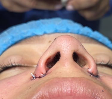Rinomodelación con ácido hialurónico en clínica de armonización facial en Santo Domingo
