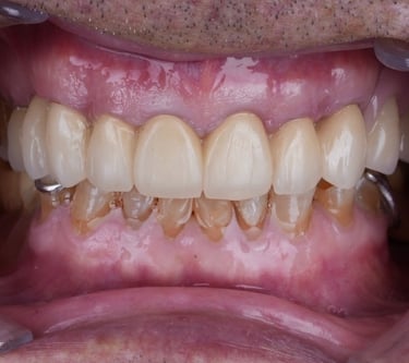 Procad Henares,rehabilitación metal cerámica recién cementado