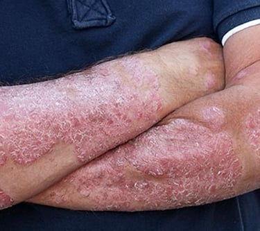 A man with psoriasis on his arms, seeking psoriasis treatment in Vadodara. Find the best dermatologist near you