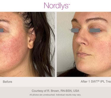 skin analysis and consultation for treatment planning in Hamilton skincare clinic
