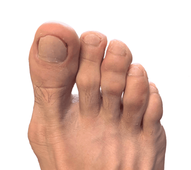 Tratamiento-Onicomicosis-Exitoso