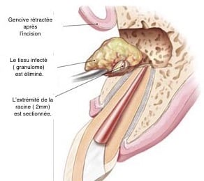 Chirurgie endodontique