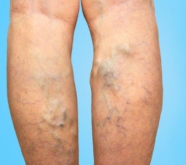 vascular ultrasound varicose vein swelling pain sclerotherapy leg ulcer radiofrequency laser ablation insufficiency chronic