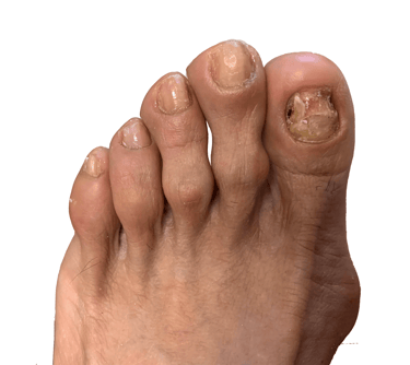 Onicomicosis-hongos-uñas