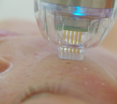 RF microneedling radiofrequency microneedling