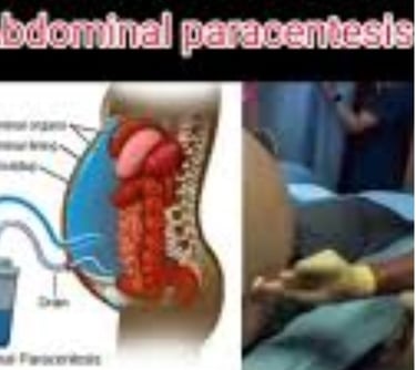 Abdominal Paracentesis Diagnostic and Therapeutic