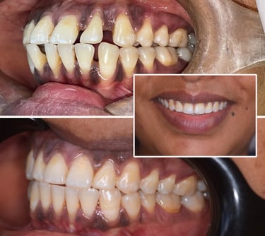 gaps in teeth closed using invisble braces by best orthodontist in malad west mummbai