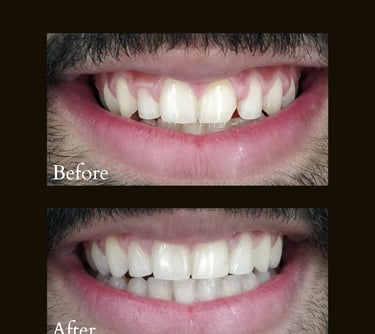 Bleeding gums treatment and Ceramic Veneers by Gums Specialist near Goregaon Mumbai