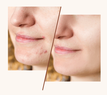 Before and after comparison of facial acne treatment showing clear skin results on chin and lips.