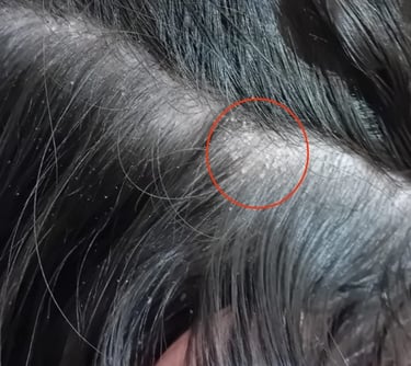 Image d'un cuir chevelu souffrant de sécheresse, entourée en rouge