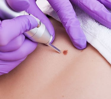 Achieve clear skin with top-notch mole removal and skin tag removal treatments in Vadodara.