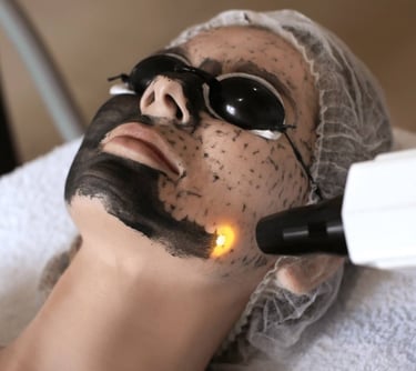 Woman receiving carbon facial treatment in Vadodara, wearing black face mask and eye mask for glow facial
