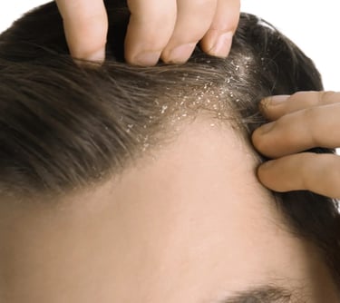 Top dermatologist in Vadodara offers effective dandruff treatment
