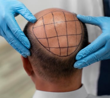 Enhance your look with a hairtransplant by the best dermatologist in Vadodara. Visit for a hair transplant today!