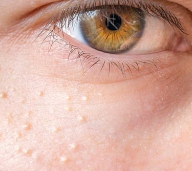 Close-up of eye with white spots. Seek millia treatment from the best skin specialist and dermatologist in Vadodara