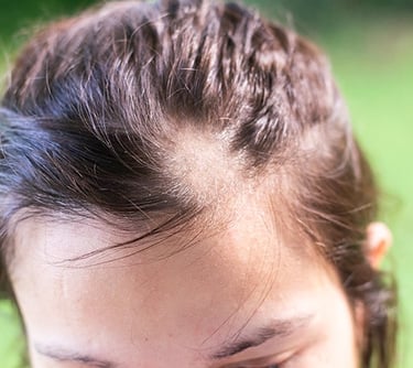 A professional psychiatrist in Vadodara offering effective treatment for hair pulling disorder (trichotillomania)