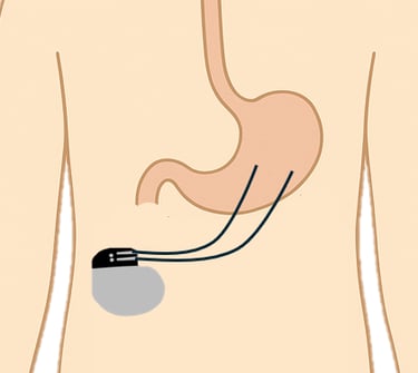 pacemaker gastrique