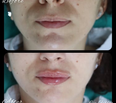 lip filler Antalya Turkey