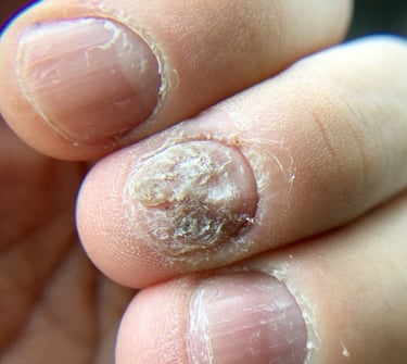  A person holding a nail with a white spot, symbolizing nail infection treatment in Vadodara by the best skin specialist