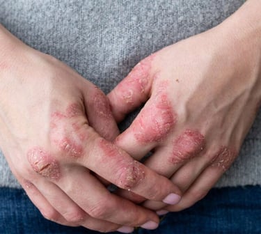 psoriasis ceniza curativa agnihotra homa argentina