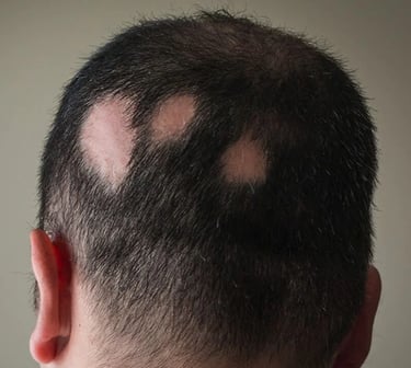 Vadodara's best dermatologist offers alopecia treatment for bald patch, skin specialist