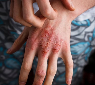 A person's hands with a rash, seeking eczema treatment in Vadodara. Find the best dermatologist near you