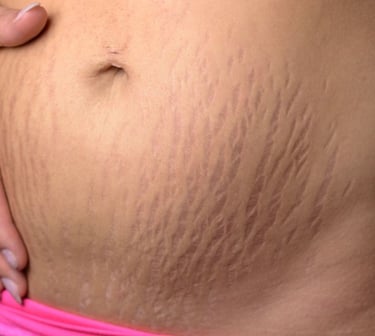 A woman's stomach with a prominent scar. Seek stretch mark treatment in Vadodara from the best skin specialist near you