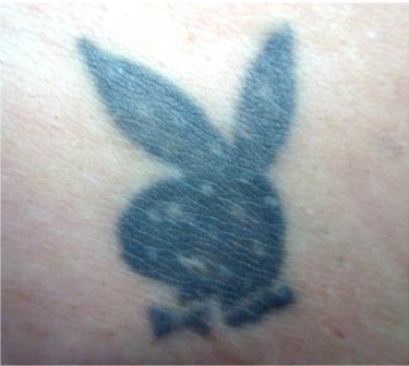 electrolysis-and-tattoos