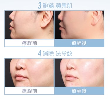 BTL臉部成效見證