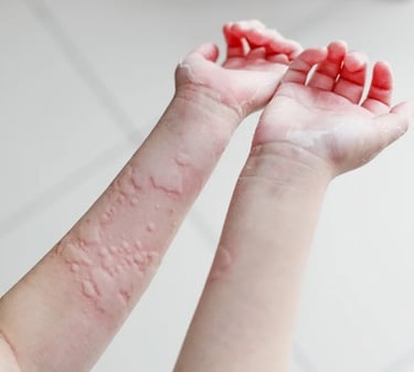 Child with skin rash on hands, seeking urticaria treatment in Vadodara. Skin allergy treatment. Best skin specialist vadodara