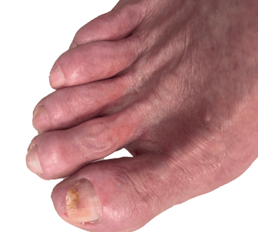 Toe Nail Fungus of client after recieving a Medical Pedicure in Boise Idaho