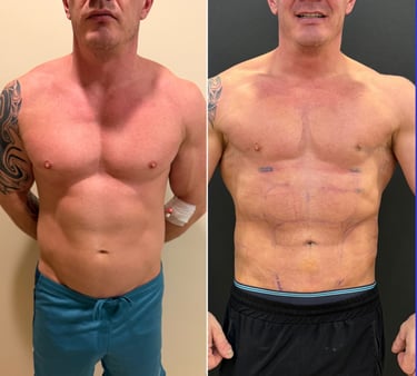 liposuction before after photos in Antalya, Turkey