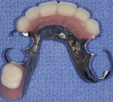 a image showing partial denture