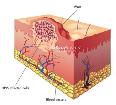 ultraplasma.com_wart_treatment_sigil_tedavisi_ultra_plasma_ultra_plazma_verruca vulgaris
