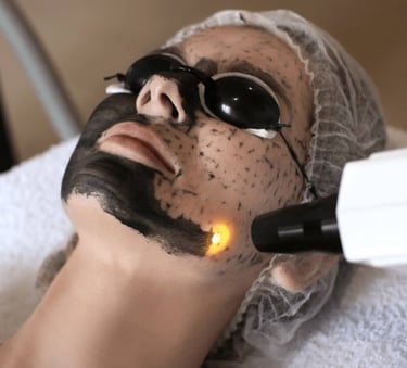 Woman receiving carbon facial treatment in Vadodara, wearing black face mask and eye mask for glow facial