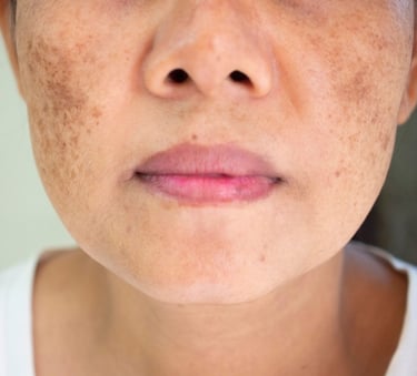 Melasma treatment in Vadodara at the best skin clinic near me