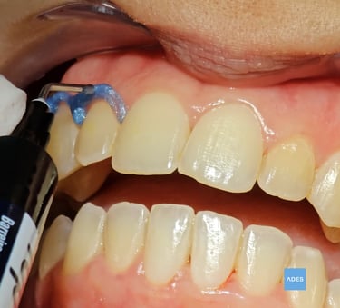 blanqueamiento dental