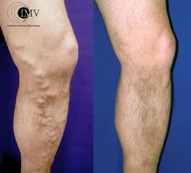 Dilataciones Varicosas, Antes y después, Varices, Cambrils, Tarragona, Instituto Médico Vilafortuny,