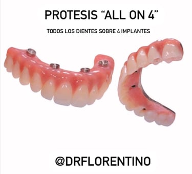 All on 4 dental implants
