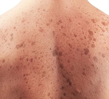 Pigmentation treatment in Vadodara for glowing skin. Visit the best skin clinic near you for effective glow treatment
