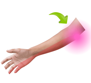 sindrome de tunel cubital, medico neurocirujano, dolor, nervio perifericos