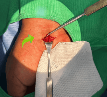 Sindrome de tunel de carpo, cirugia de nervios perifericos, dr tafur mejro neurocirujano