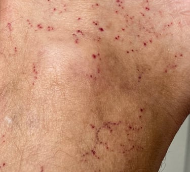 little hematomas on the foot