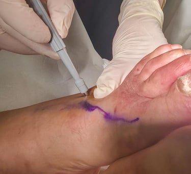 "Punch biyopsi yöntemi ile doku örneği alınması