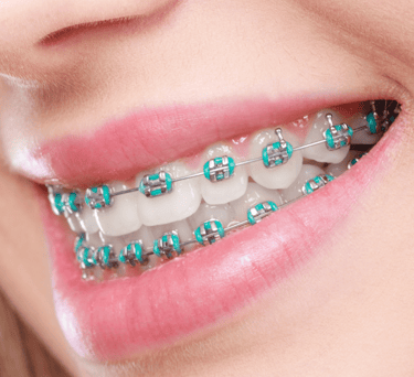 braces solution in baner